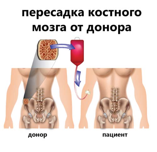 Preview Акилле Полонара: Найден донор для трансплантации костного мозга